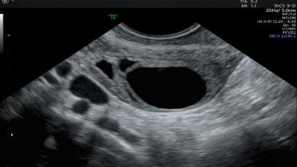 Ovarian Cyst - Types, Symptoms & Treatments