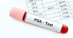 Psa Test Report Code Who Needs a PSA Test? Normal Levels and Guidelines